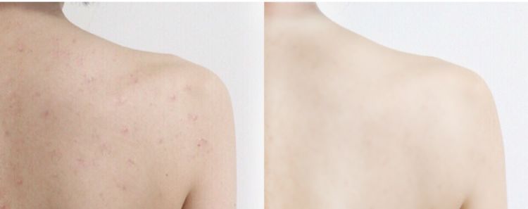 玻尿酸制作中如何干燥,玻尿酸3小时保湿力