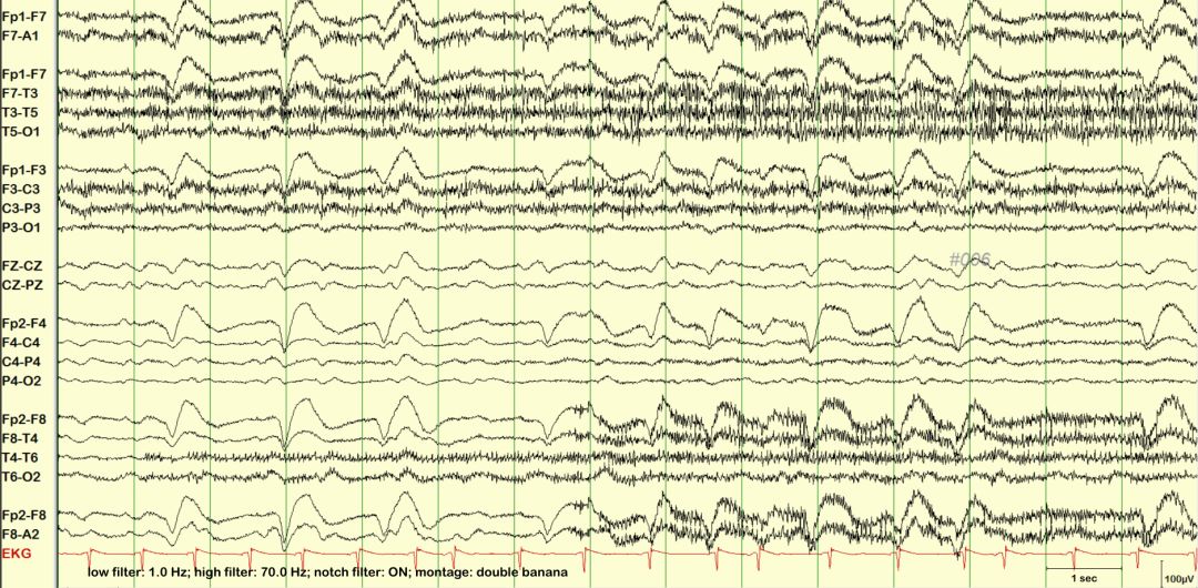 脑电图伪差图,脑电图伪差图谱