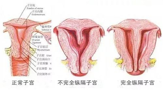雅安恒博医院提醒:子宫有这道“墙”需及时“拆除”