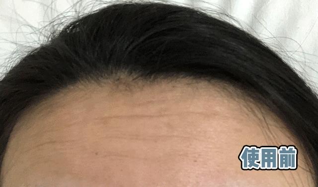 抬头纹眉间纹怎么去除,眉间纹抬头纹去除最好的方法