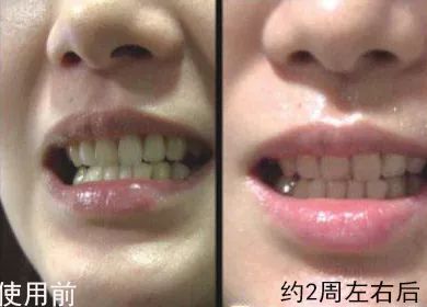 不用打磨牙齿的快速美白方法,不用洗牙能把牙垢黄牙变白的方法