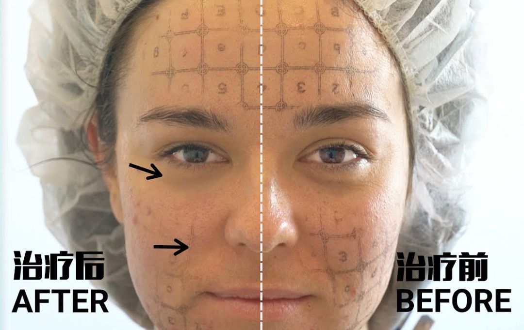 热玛吉抗衰老手术适应6类人群,了解热玛吉抗衰老看这篇就够了