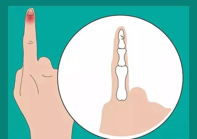 打篮球手指关节痛,篮球戳伤手指什么感觉