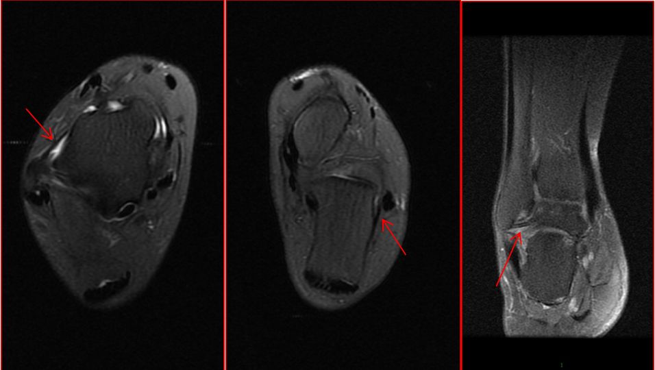 崴脚了医生建议拍片吗,崴脚后核磁可以看到软骨损伤么