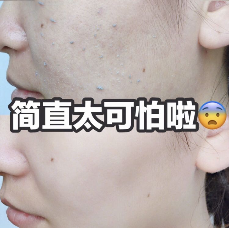 脸上搓下来很多泥,脸上搓出黑头