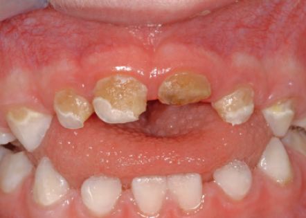 关爱口腔预防龋齿,爱牙科普小实验