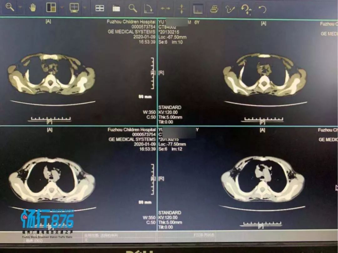福州一男童上半身充斥气泡，作为家长，值得警醒