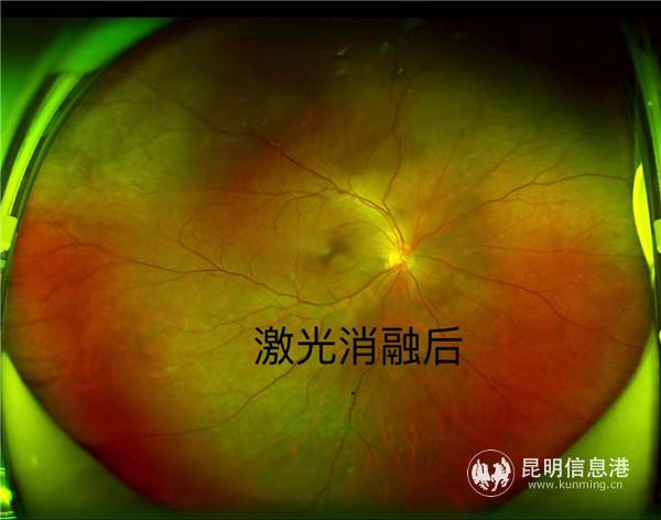 高度近视飞蚊症动手术,三十岁高度近视飞蚊症