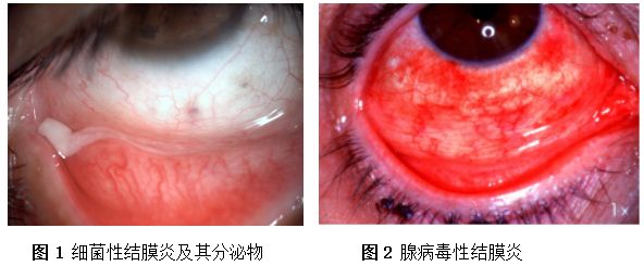 结膜炎的种类及传染性,最近疫情中的结膜炎是什么类型的