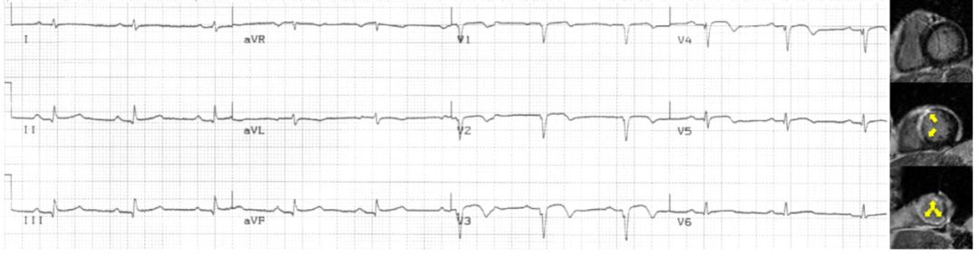 单纯心电图能判断心肌梗死吗,心电图判断冠心病准确吗