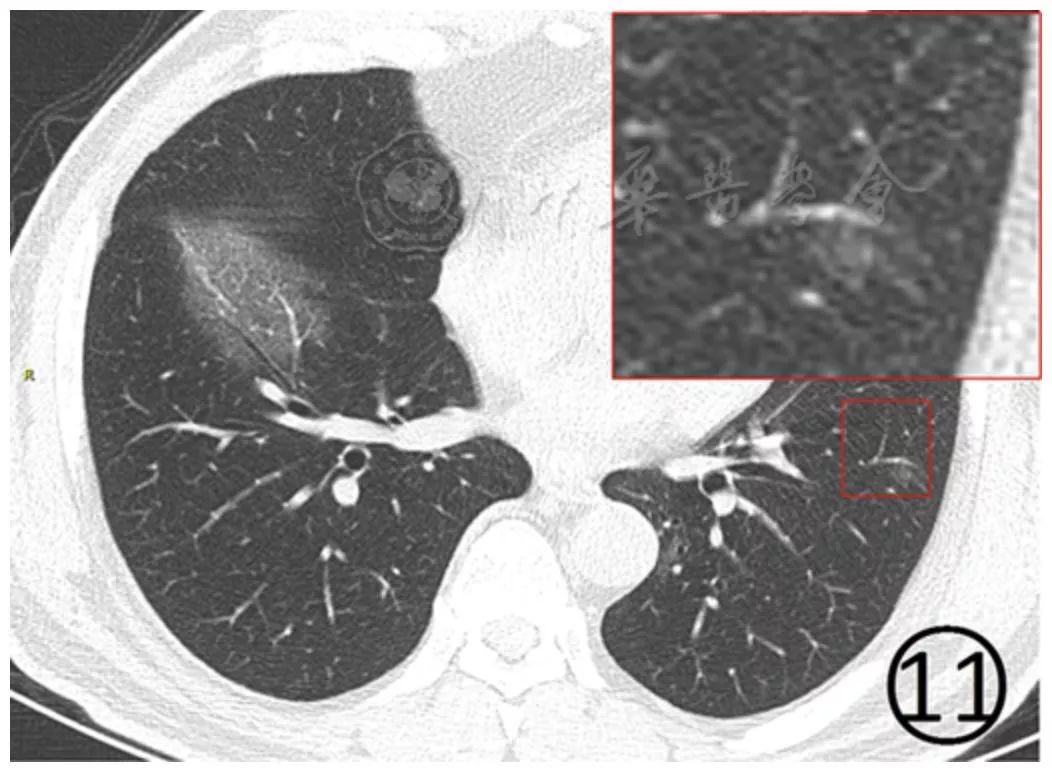 新冠肺炎影像演变过程,新冠肺炎胸部影像学特点有哪些