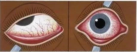 在疫情期间得结膜炎说明什么,疫情期间结膜炎有什么症状