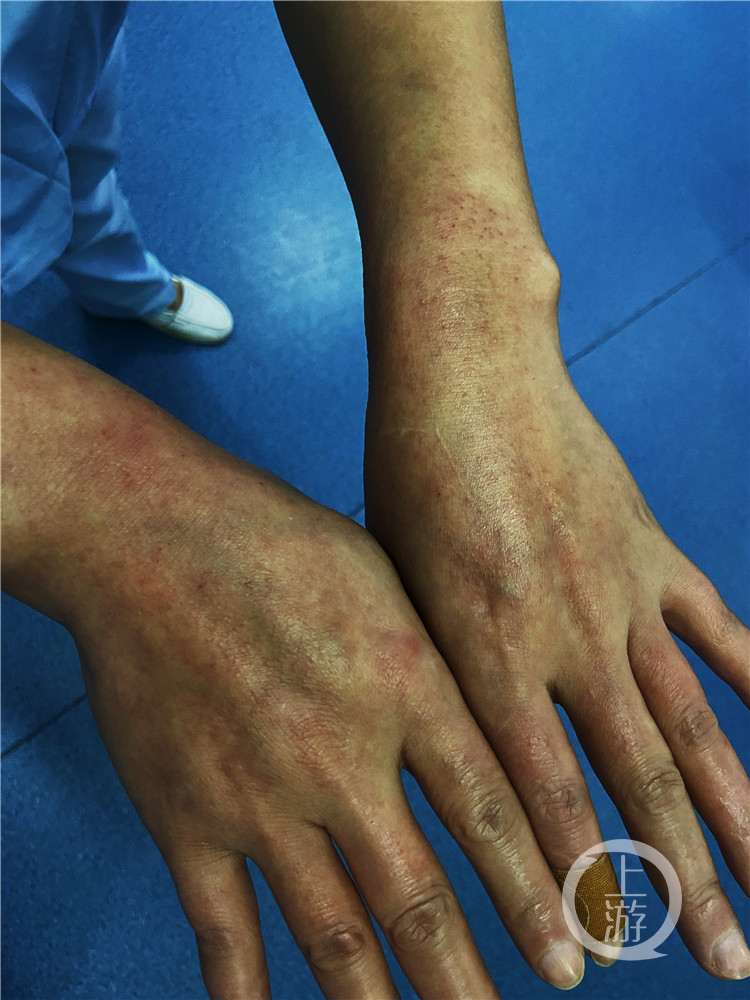 这双长满红疹的手，是“疫”线最美的双手