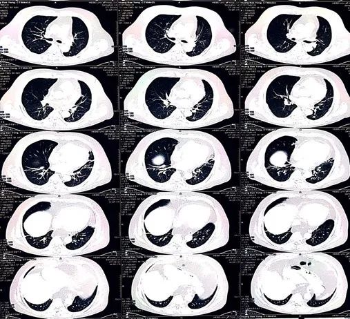 病例丨“一波三折”的三度房室传导阻滞，原因何在？