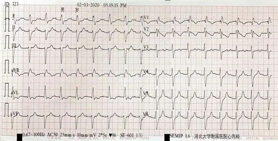 一度房室传导阻滞是怎么得的,三度房室传导阻滞最简单看法