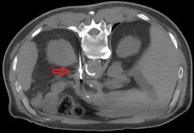 在线心内会诊室丨原醛治疗,“柳暗花明又一村”