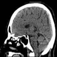 延髓外侧综合征口诀,延髓背外侧综合征典型病例