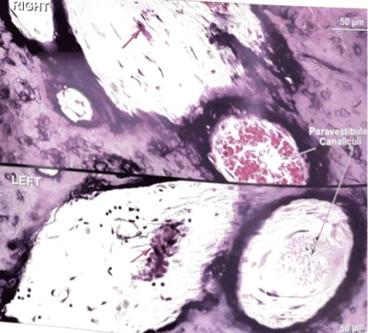 梅尼埃病深度解析,梅尼埃病病理解剖