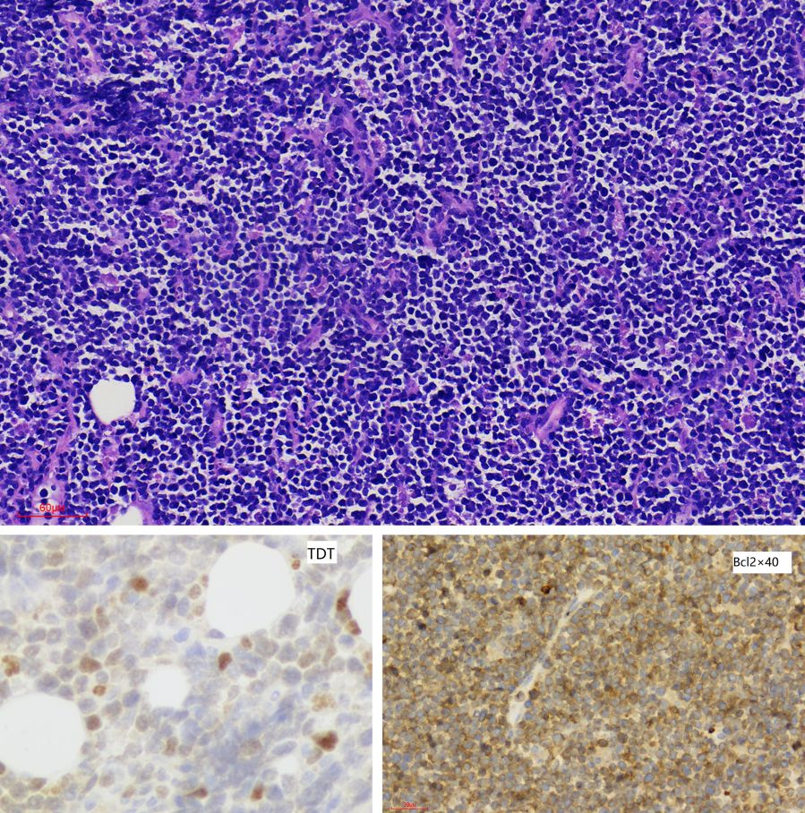 2020年淋巴瘤病理诊断必备知识点,淋巴瘤病理质控