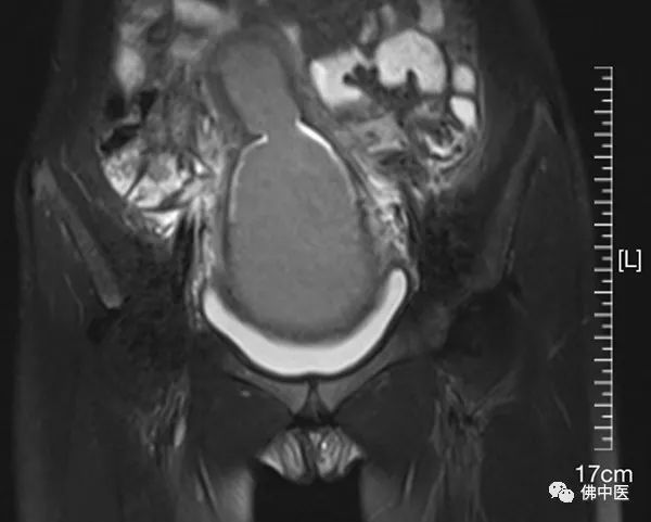 【高超】改写“石女”命运！佛中医妇科实施高难度罕见阴道成形术
