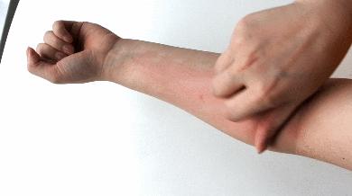 长小水泡很痒用什么中药,皮肤止痒起包用哪个药膏