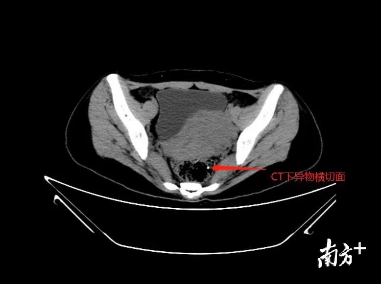 一女子怀疑得痔疮,一名女子得了痔疮结果痔疮破裂