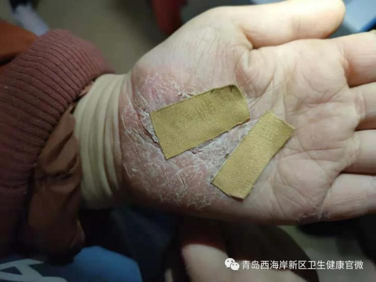 春季湿疹反复发作怎么治疗,湿疹反复痒怎么办