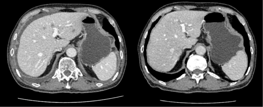 老人结肠癌晚期做了造口,76岁老人造口手术