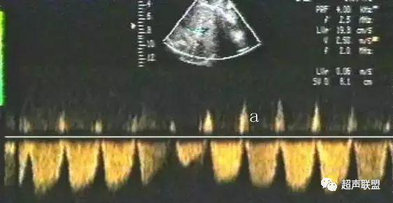 胎儿宫内窘迫通过什么检查出来的,胎儿宫内缺氧的超声视频