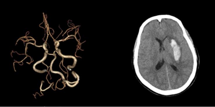 左侧大脑后动脉开窗畸形图片,脑部基底动脉开窗畸形如何治疗