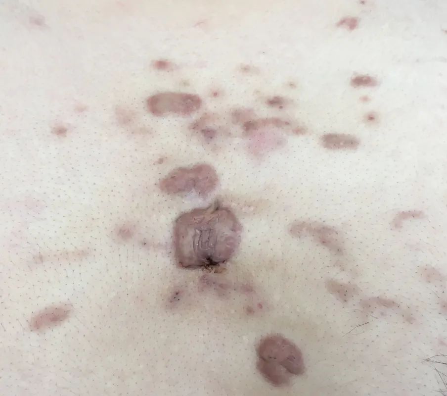 瘢痕体质留疤了怎么办,只有开刀才长疤是瘢痕体质吗