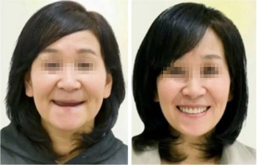 昆明独生子父母可以领补贴吗,昆明怎么领取补贴