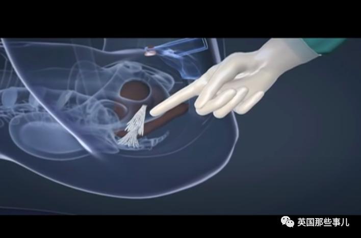 做变性手术的所有过程,变性手术全过程