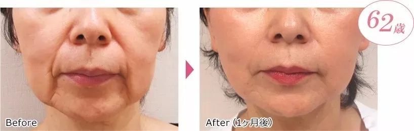 长期补充胶原蛋白的人怎么样了,长期喝胶原蛋白的人最后怎么样了