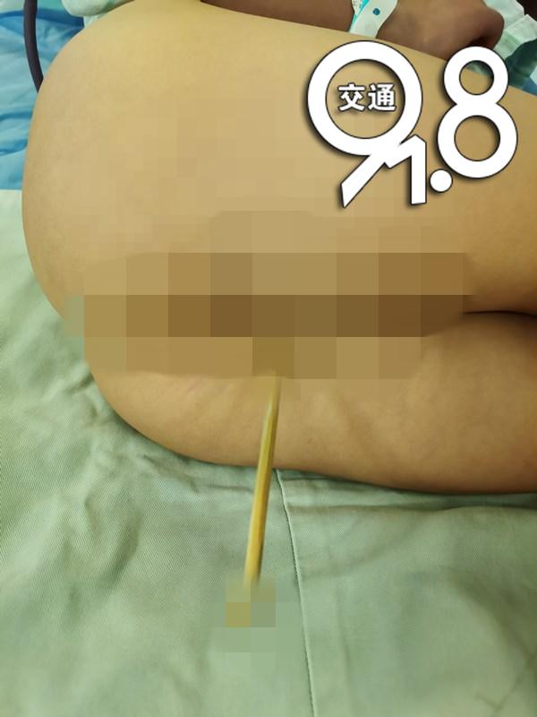 儿童被竹签扎到,3岁女童被竹签刺