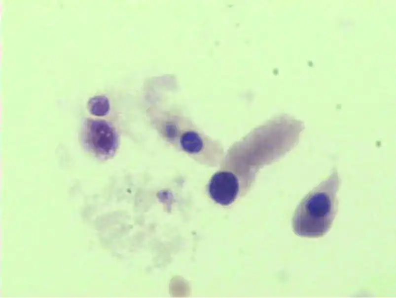 尿液中的有形成分红细胞,尿液中常见的有形成分