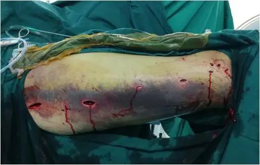 骨科微创手术动画,背部骨科微创手术