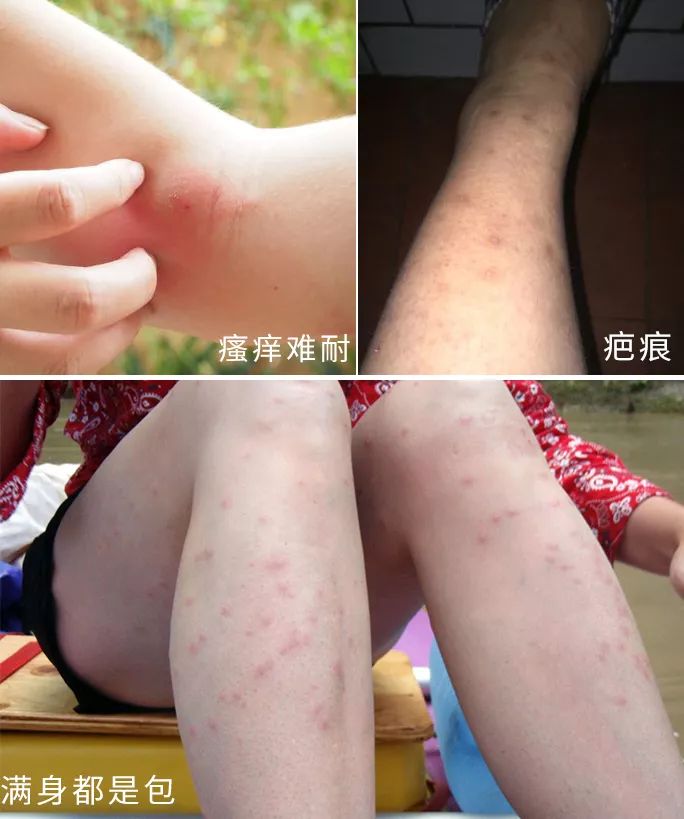 1罐搞定一整夏！20秒止痒消肿，让蚊虫再无嚣张机会