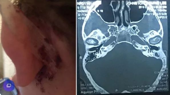 棉签抠耳朵导致癫痫,用棉签掏耳朵不小心被撞了一下
