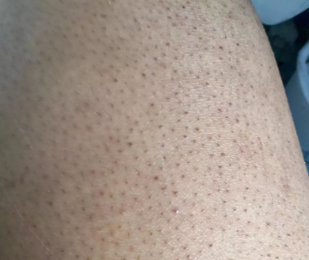 别放弃，烦人的“鸡皮疙瘩”，真的还可以再救一下