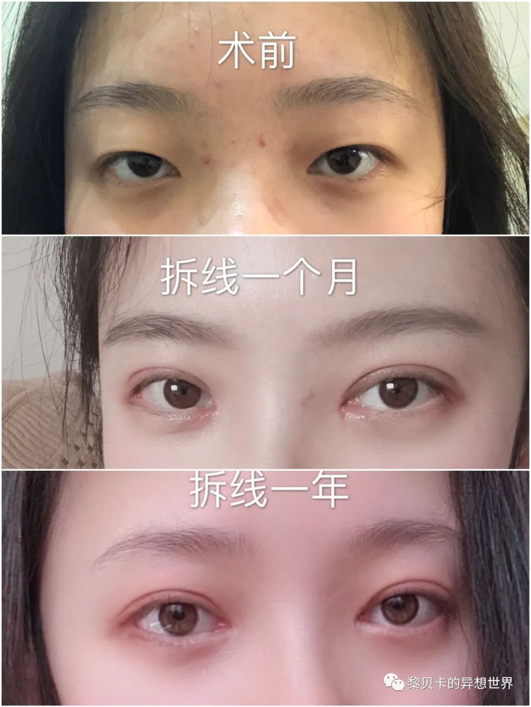 做完医美真的能换脸吗,做完医美需要注意什么