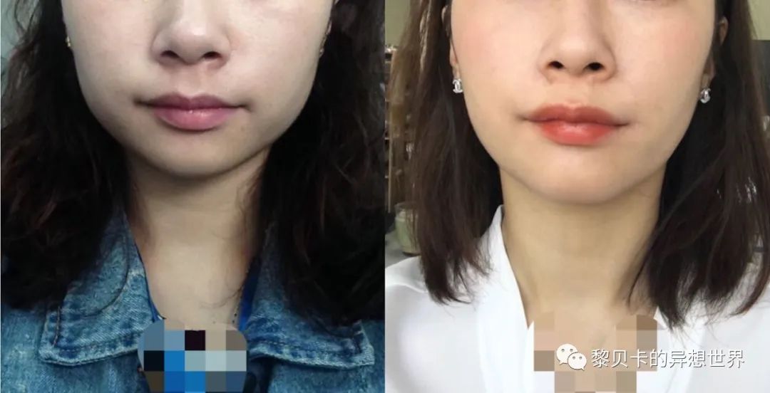 做完医美用可复美吗,你知道做完医美有多可怕