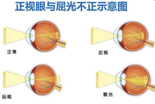 老中医治疗近视眼特效秘验方,全国爱眼日如何预防近视