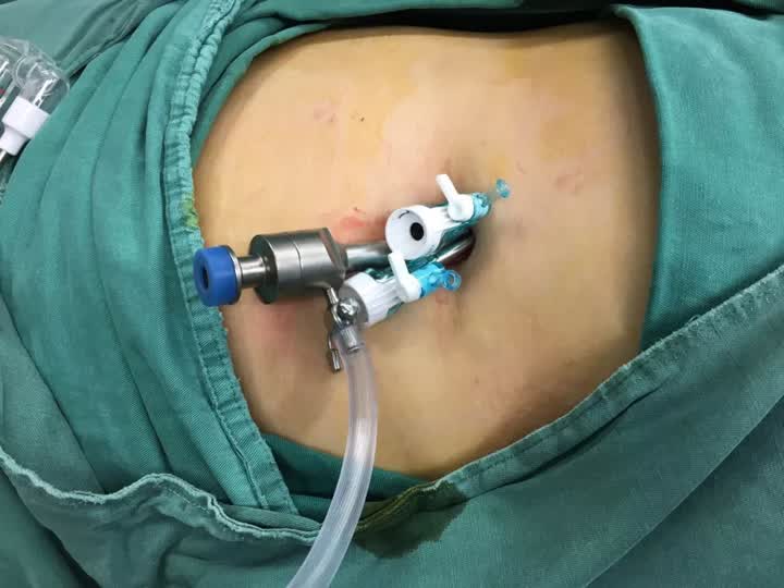 单孔腹腔镜手术南通,单孔腹腔镜手术后康复