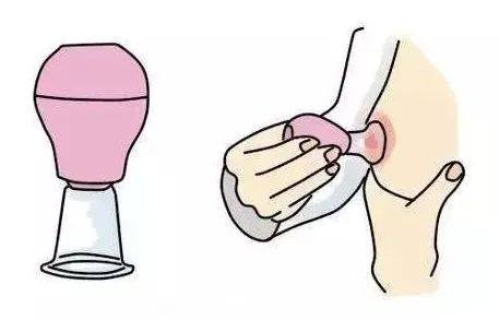 19岁女孩乳头一直没长出来父母后悔听信“老人言”