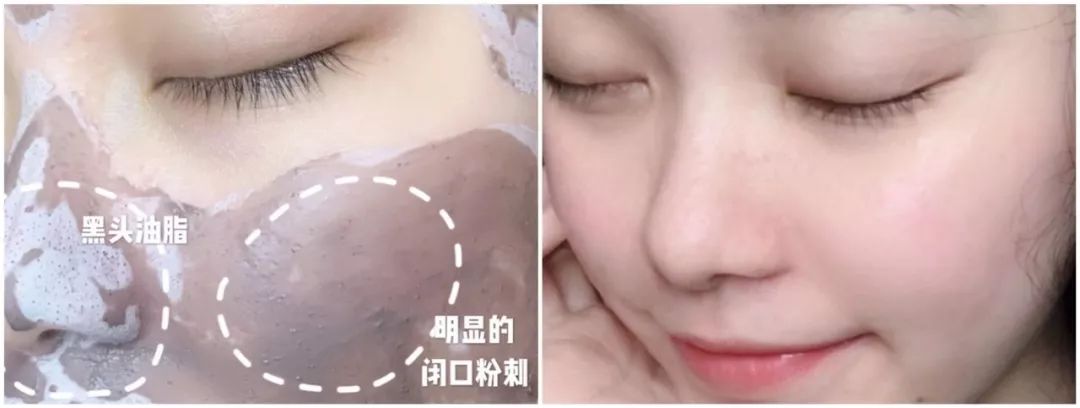 超微小气泡毛孔吸尘器使用方法,毛孔吸尘器去黑头收缩毛孔