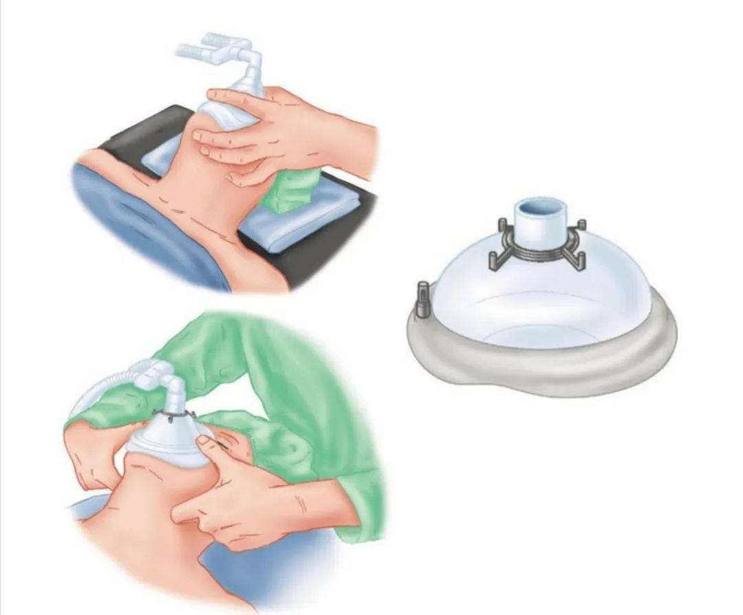 气道异物患者麻醉,小儿气道异物麻醉