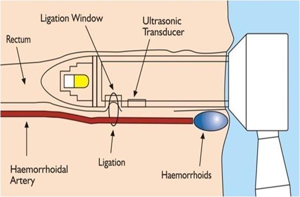 超声多普勒引导下痔疮手术多少钱,超声多普勒治疗痔疮优缺点