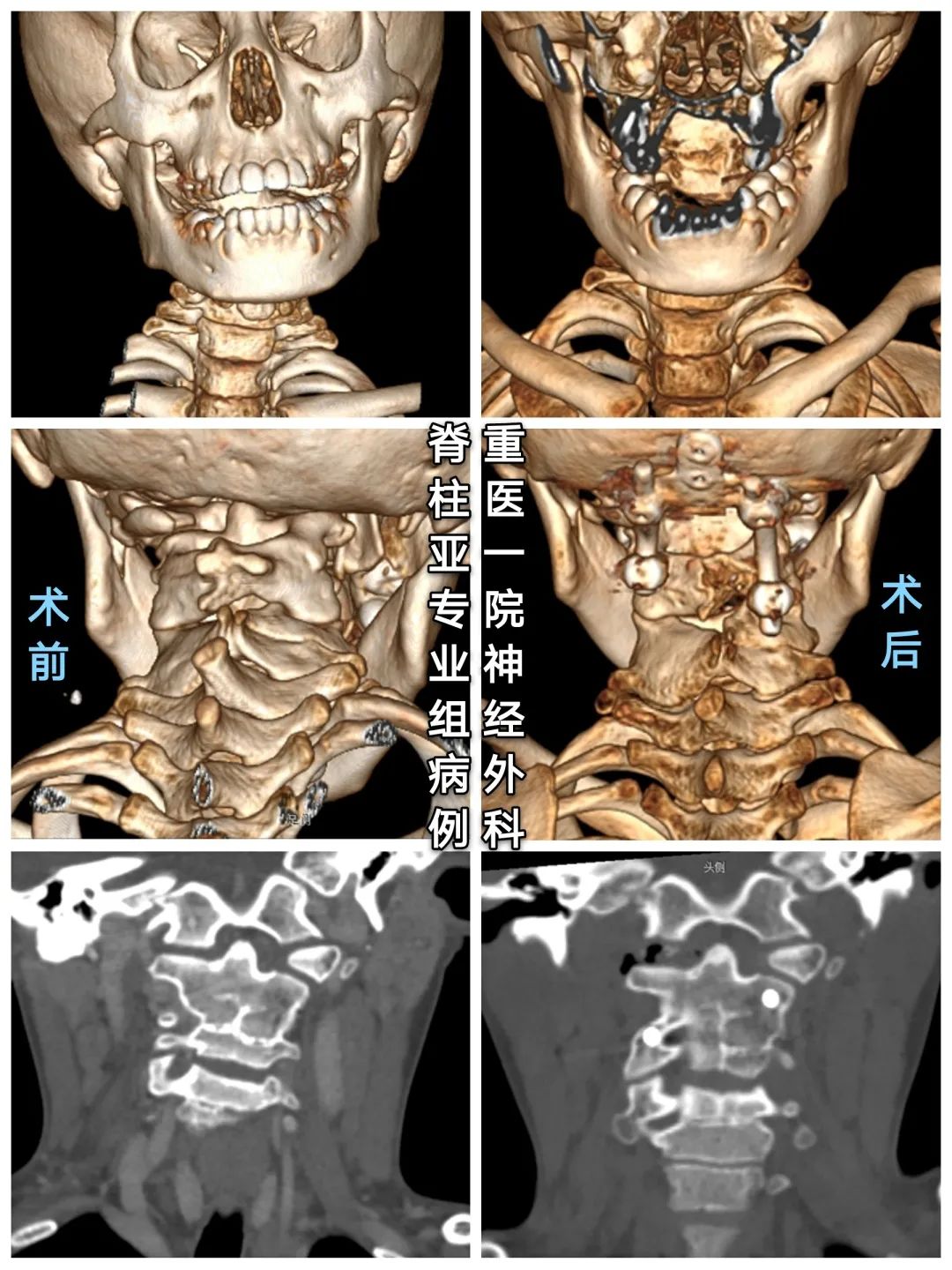寰枢椎半脱位与痉挛性斜颈,寰枢椎发育畸形