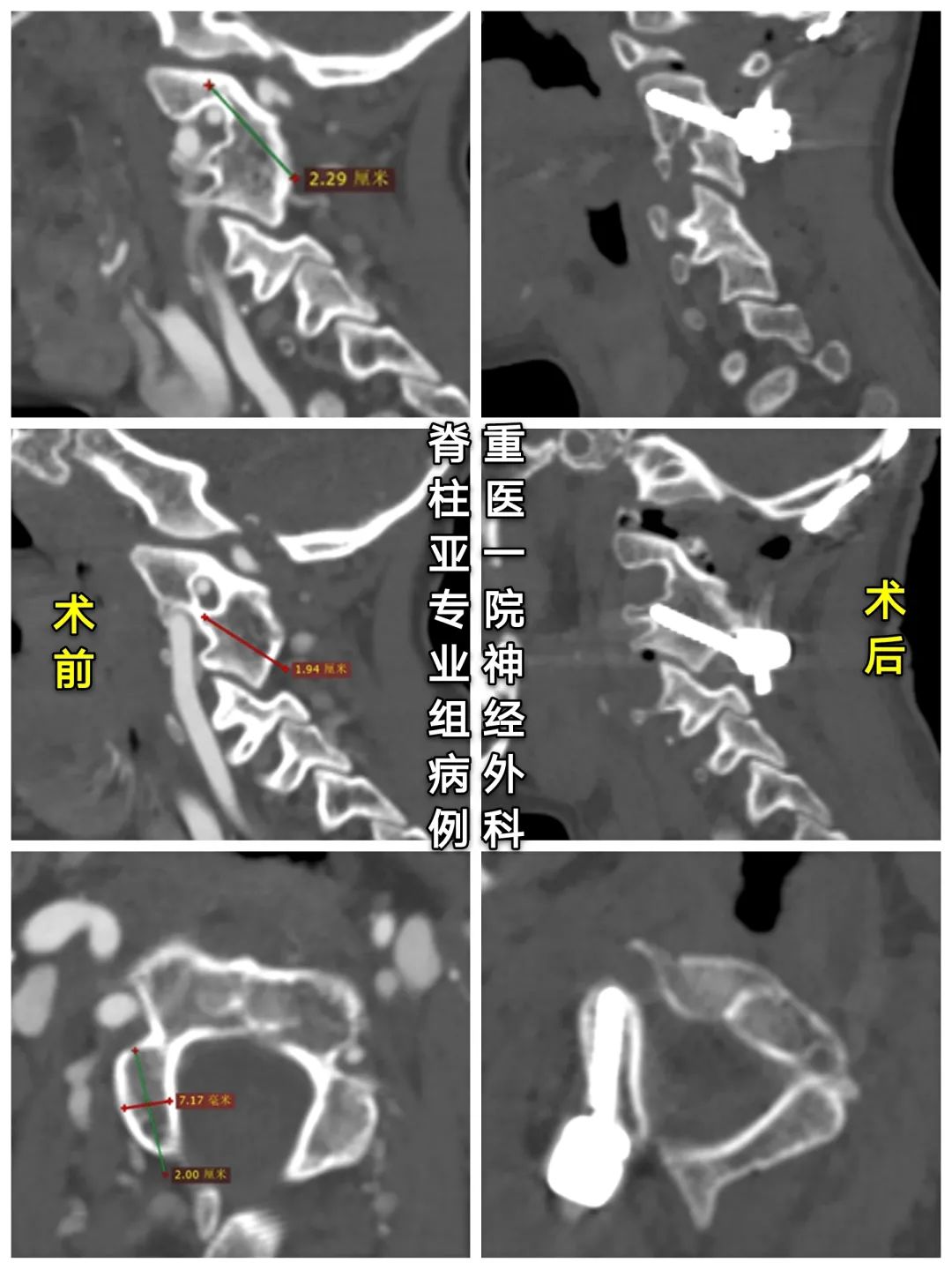 寰枢椎半脱位与痉挛性斜颈,寰枢椎发育畸形